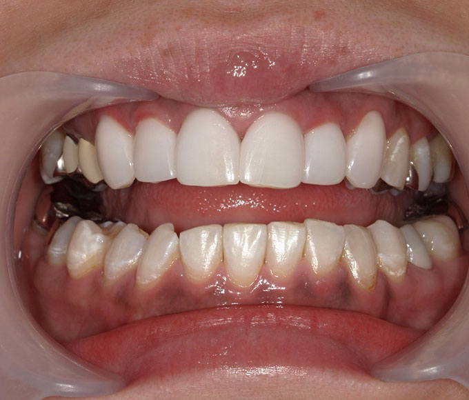 ホワイトニング アフター写真