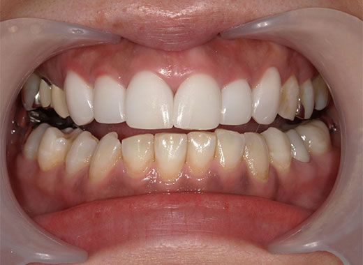 ホワイトニング ビフォー写真