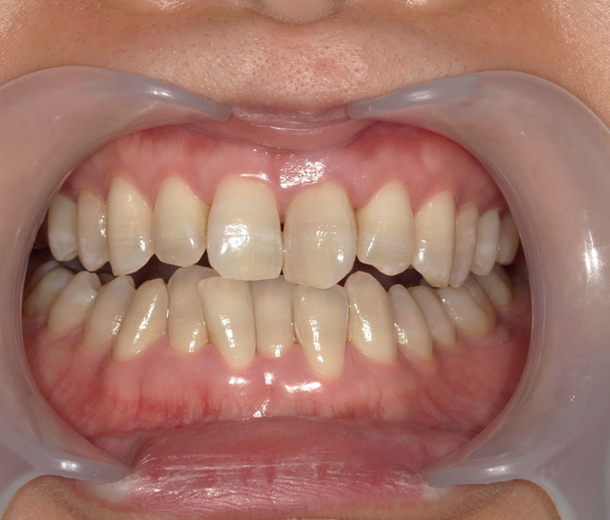 ホワイトニング アフター写真
