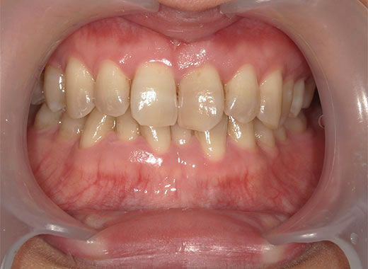 ホワイトニング ビフォー写真