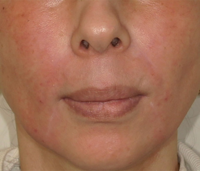 ヒアルロン酸注入 アフター写真