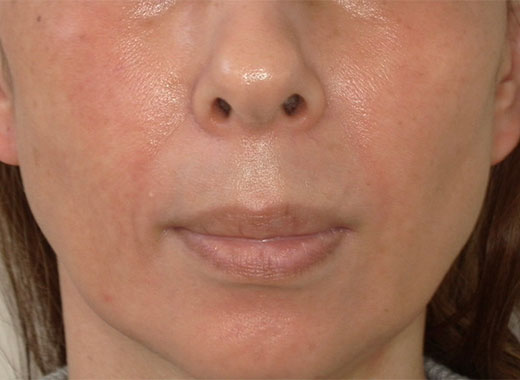 ヒアルロン酸注入 ビフォー写真