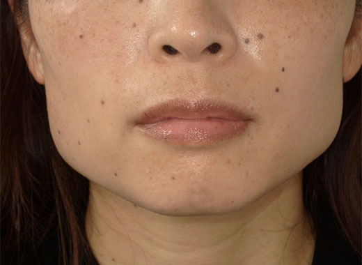 ボツリヌストキシン製剤療法 ビフォー写真